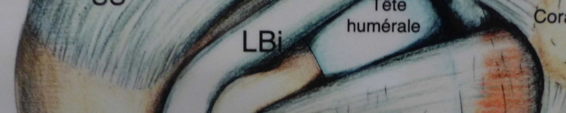 Pathologie de la coiffe des rotateurs et arthrose de l’épaule