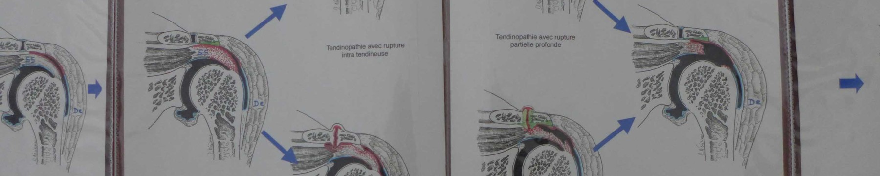 Évolution des lésions de la coiffe
