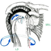 détournement - transfert du tendon grand dorsal