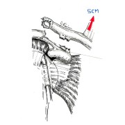 Fig. 2.: dislocation de l'articulation par rupture des ligaments entre clavicule et omoplate