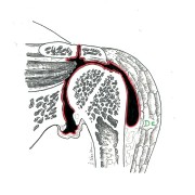 Fig.1: arthose généralisée et dislocation de l'articulation (en rouge) 