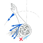 Fig. 4: Perte des rotateurs externe (croix rouge sur bleu clair) = la main tourne vers le ventre