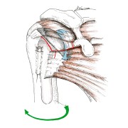 Fig.3: Mini-ouverture pour pose de PTE: tendons moins agressés