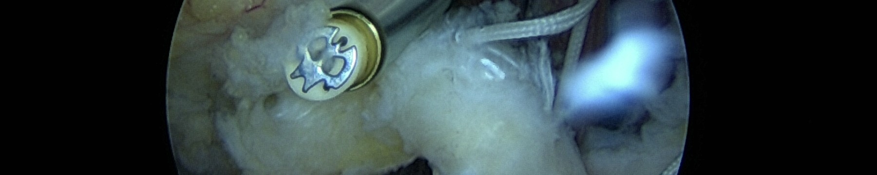 Disjonction Acromio-Claviculaire