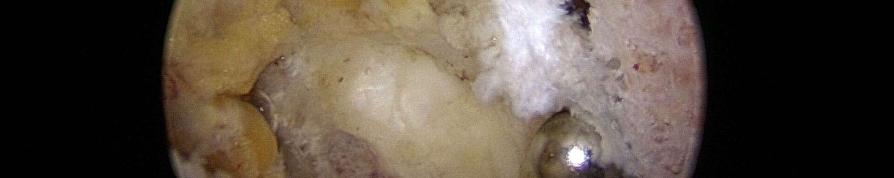 Luxations antérieures répétées de l’épaule – Butée et Bankart