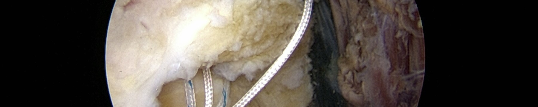 Tendinopathies de la coiffe des rotateurs