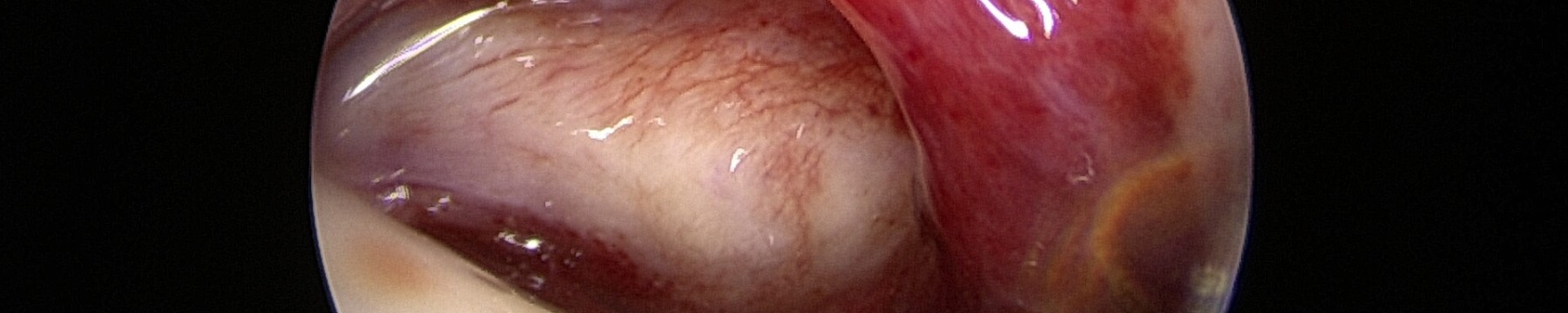 Pathologie synoviale et corps étrangers libres