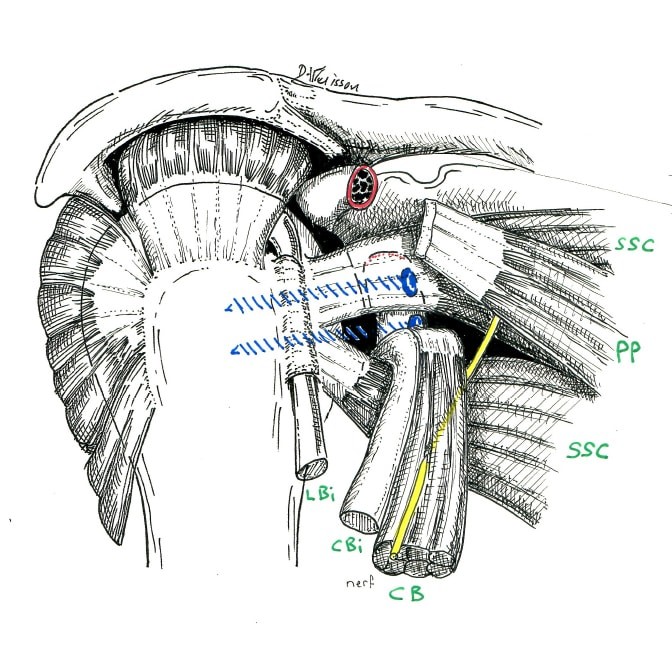 Butée d'épaule en place à travers le muscle SSC. En jaune le nerf de la flexion du coude