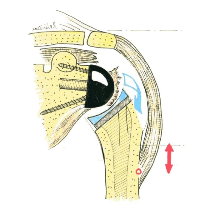 Fig.2: PTE inversée et réparation du tendon IS
