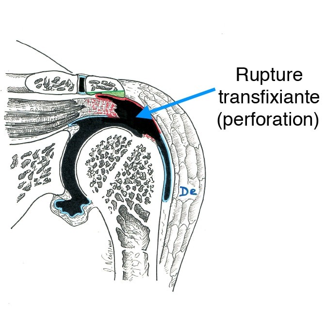 Fig. 3 : rupture transfixiante (perforation)