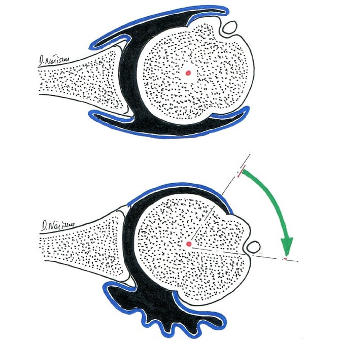 Fig. 1 : rotation de la tête humérale