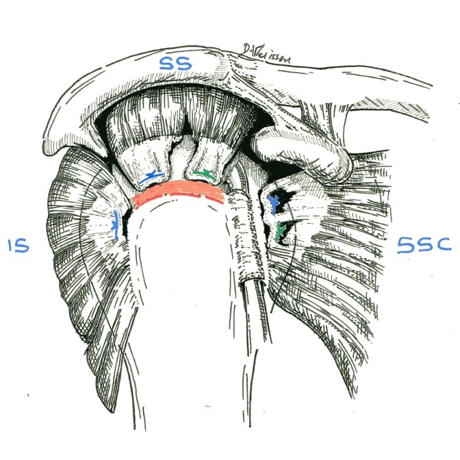 Fig.2: re-déchirure localisée au tendon SS