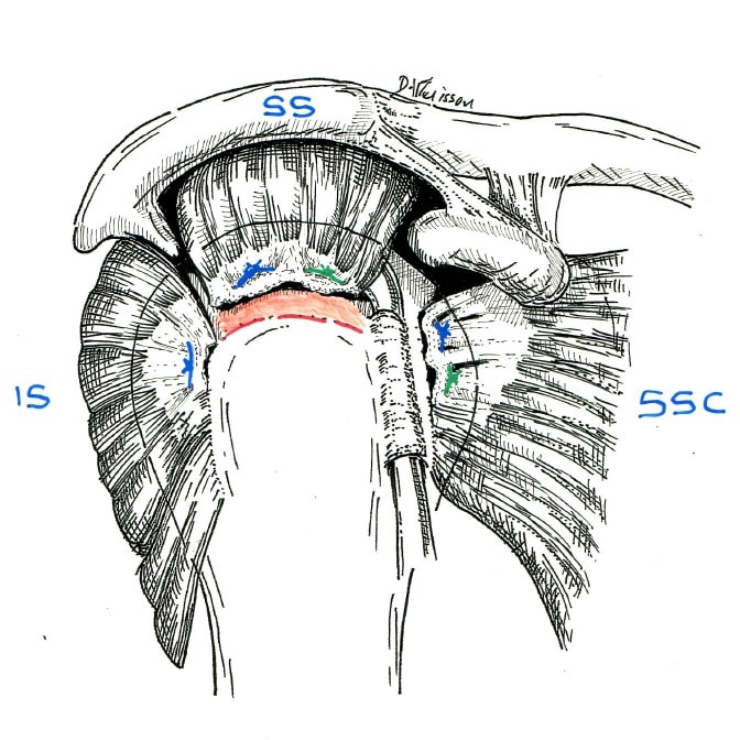 Fig.1: réparation de 3 tendons