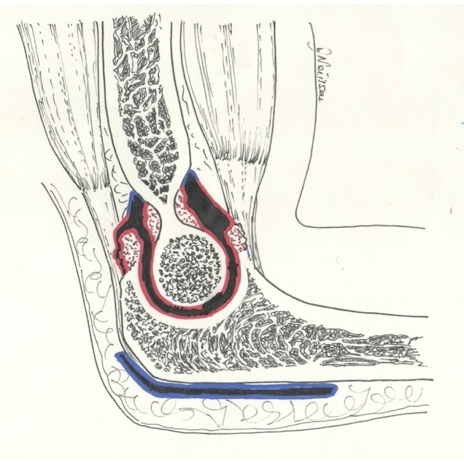 Amas fibreux entre cubitus et humérus ou arthrose du versant « ulnaire » (en rouge, cartilage malade)