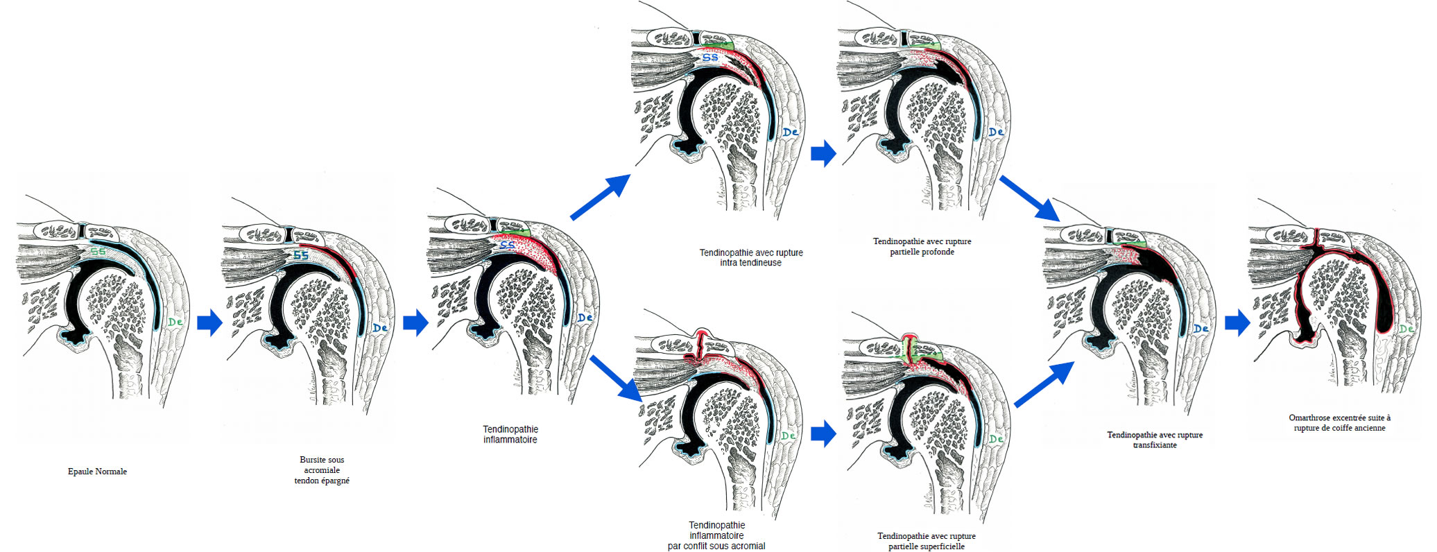 Histoire évolutive de la pathologie de la coiffe